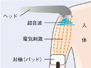 ダイナトロン　ソラリスプラスの超音波＋電気刺激コンビネーション治療